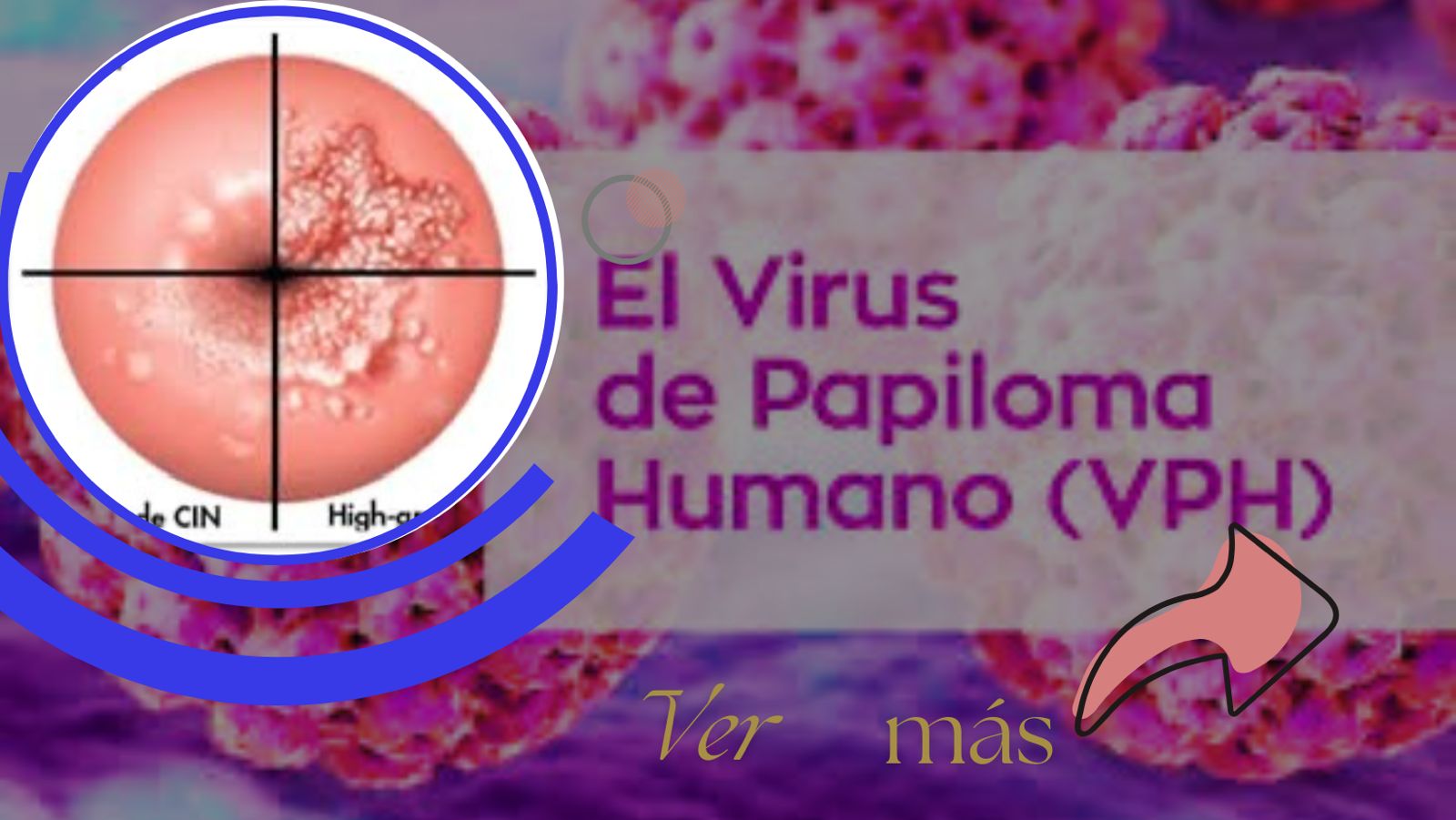 El virus papiloma humano es la enfermedad de transmisión sexual más común, puede causar cáncer en cuello útero, pene y amígdalas
