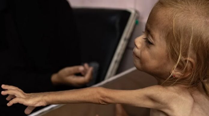 Los muertos por desnutrición en Gaza superan los 250; 108 son niños