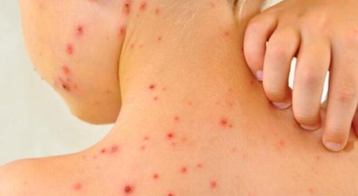 México lidera muertes por sarampión en América y es segundo en casos, según OPS