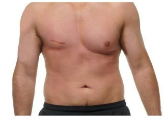 Cáncer de mama en hombres: por qué pocos saben que existe y cómo prevenirlo