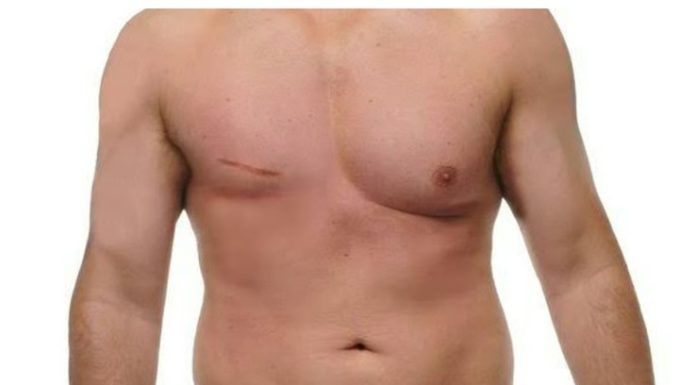 Cáncer de mama en hombres: por qué pocos saben que existe y cómo prevenirlo