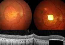 Una prótesis ocular permite leer a personas con ceguera irreversible