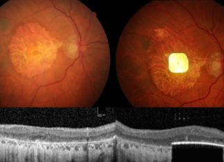 Una prótesis ocular permite leer a personas con ceguera irreversible