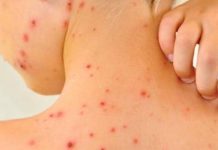 Un brote de sarampión por falta de vacunación deja ya nueve niños muertos en Israel