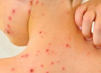 Un brote de sarampión por falta de vacunación deja ya nueve niños muertos en Israel