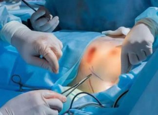 Cirujano impulsa la mamoplastia de reducción como cirugía de salud en la República Dominicana