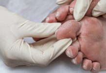 Pie diabético: una complicación frecuente que puede prevenirse con cinco recomendaciones y hábitos simples