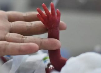 Demuestran los beneficios de transfundir sangre de cordón umbilical a prematuros extremos
