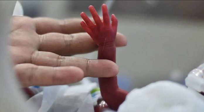 Demuestran los beneficios de transfundir sangre de cordón umbilical a prematuros extremos