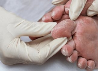 Pie diabético no duele, y por eso es más peligroso, advierte cirujano Max Guerra