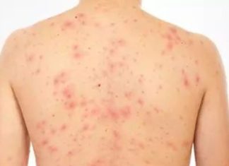 Más de 700 casos de sarampión reportados en Estados Unidos este año