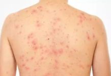 Más de 700 casos de sarampión reportados en Estados Unidos este año