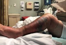 Bacteria “come carne” detectada en aguas de Long Island: puede ser mortal en solo 48 horas