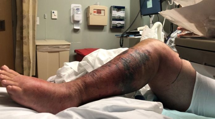 Bacteria “come carne” detectada en aguas de Long Island: puede ser mortal en solo 48 horas